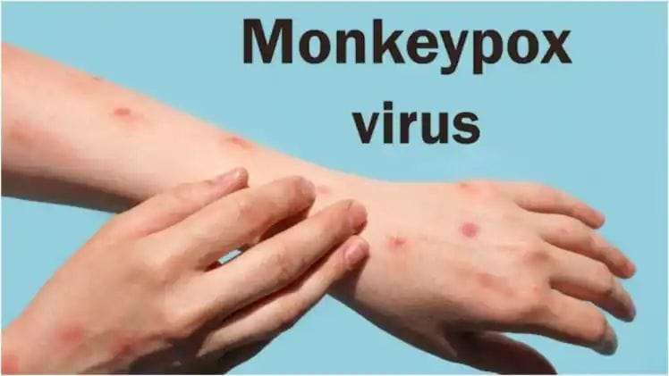 Alert issued regarding monkey pox in Uttarakhand, know how this virus spreads and how to prevent it