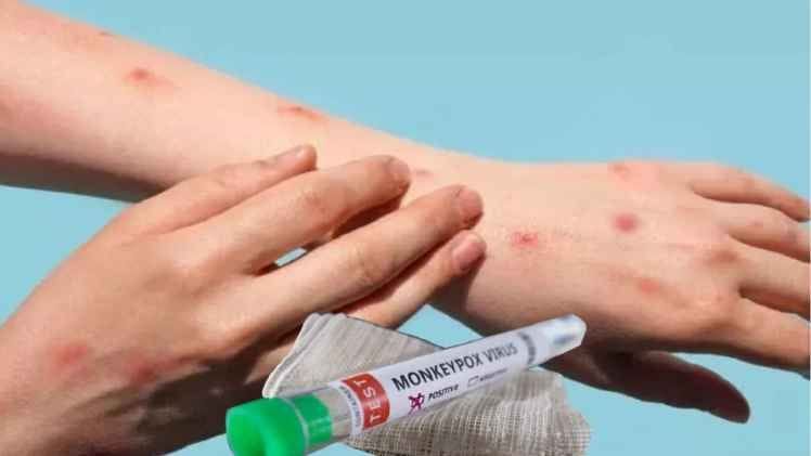 One more case of monkeypox found in the country, this disease is very dangerous, this virus is spreading, take these precautions