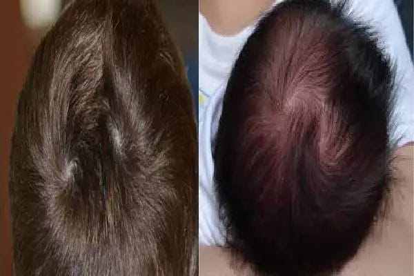 Scientific and Astrological Insights on Double Hair Whorls: Myths and Facts